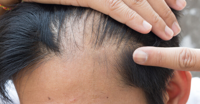 Hair Loss