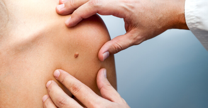 Mole Removal