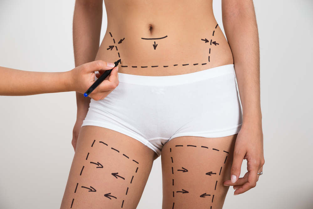 liposuction miami fl