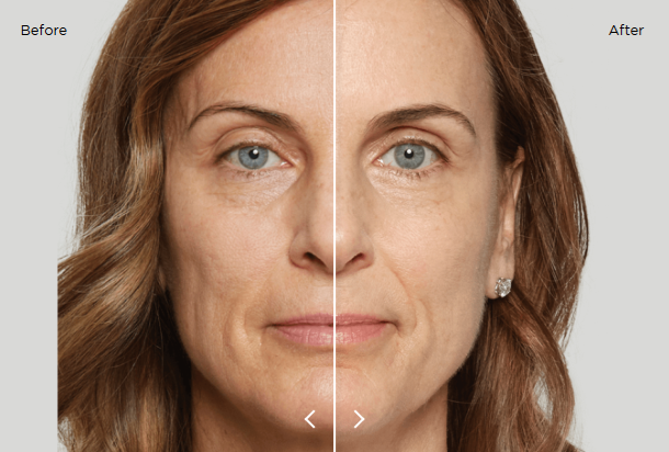 Before and after sculptra