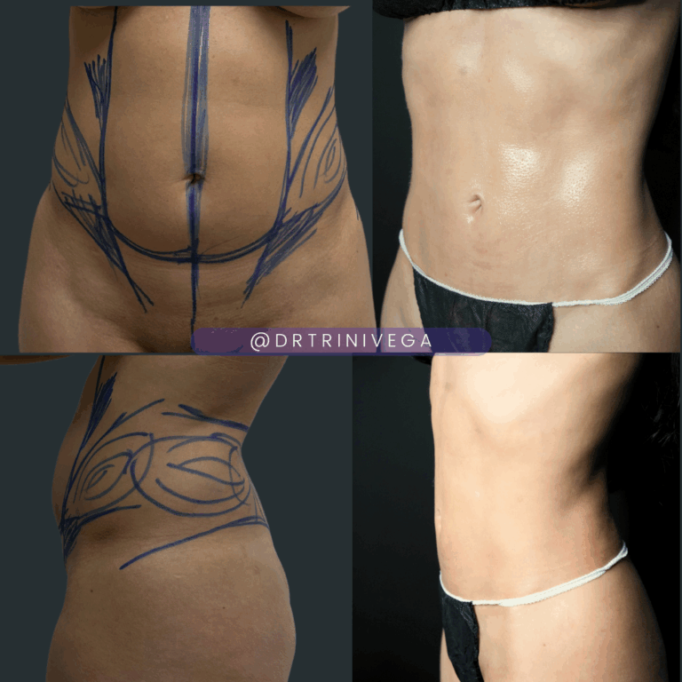 Copy of Lipo 360-HD (2)