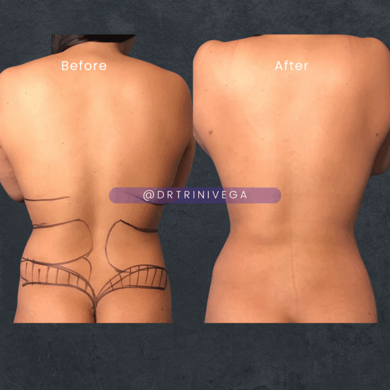 Copy of Lipo 360 HD