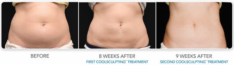 coolsculpting fat reduction results coolsculpting fat reduction results