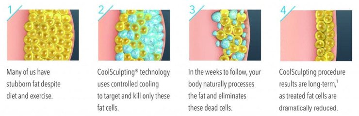 how coolsculpting works